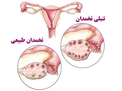 تنبلی تخمدان چه علائمی دارد و آیا درمان میشود؟