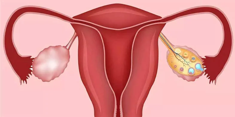تنبلی تخمدان چه علائمی دارد و آیا درمان میشود؟
